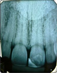 Resolução Estética Resina Composta em Dente Anterior Caso Clínico