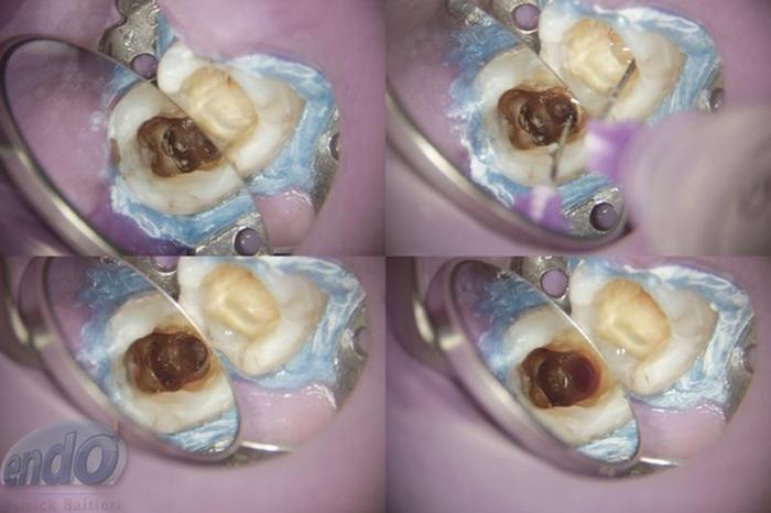 Tratamento Endod Ntico Dos Dentes Caso Cl Nico Ident