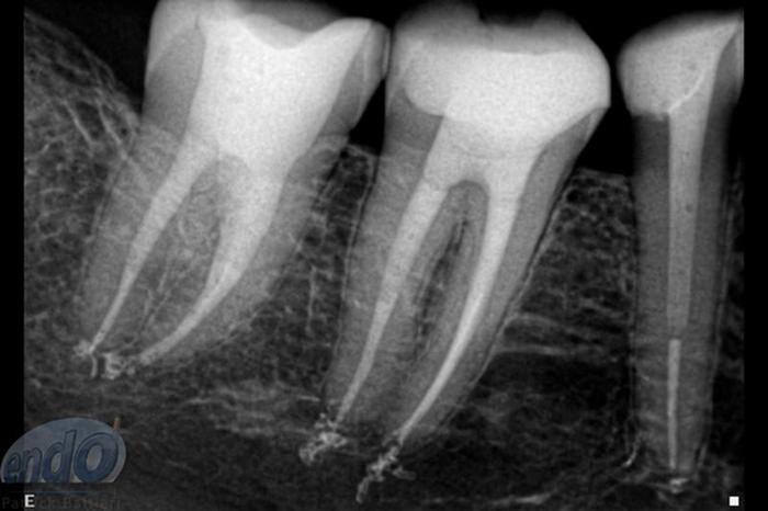 Tratamento Endod Ntico Dos Dentes Caso Cl Nico Ident