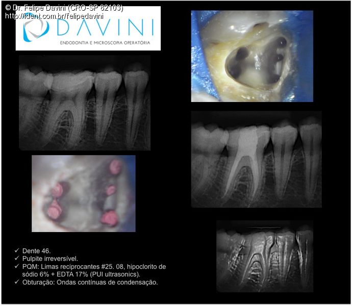 Tratamento Endodôntico em Sessão Única Molar Inferior 5 Canais