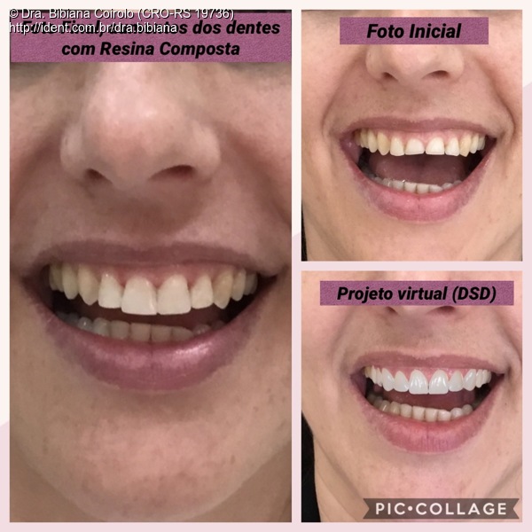 Clareamento De Dente Desvitalizado Caso Cl Nico Ident