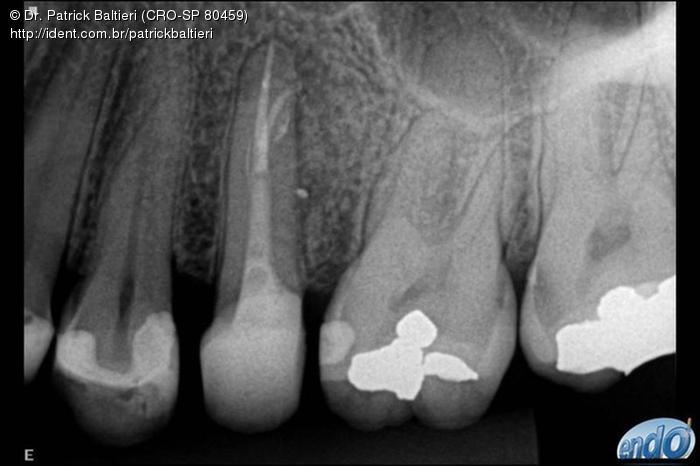 Retratamento Endodôntico de Pré Molar Superior Caso clínico iDent