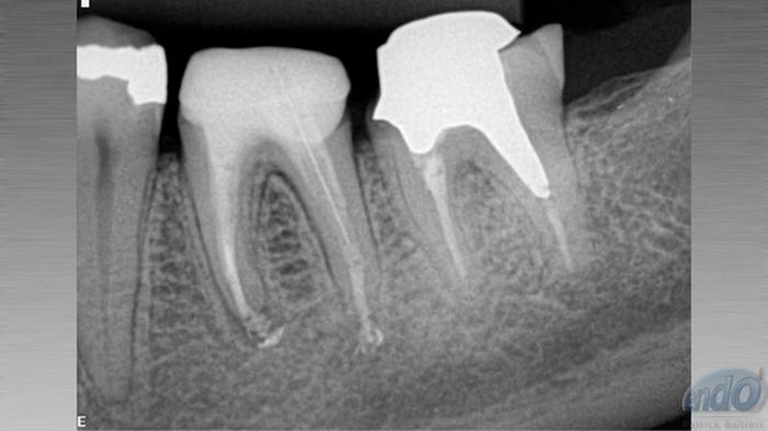 Retratamento Endodôntico Dente Caso clínico iDent