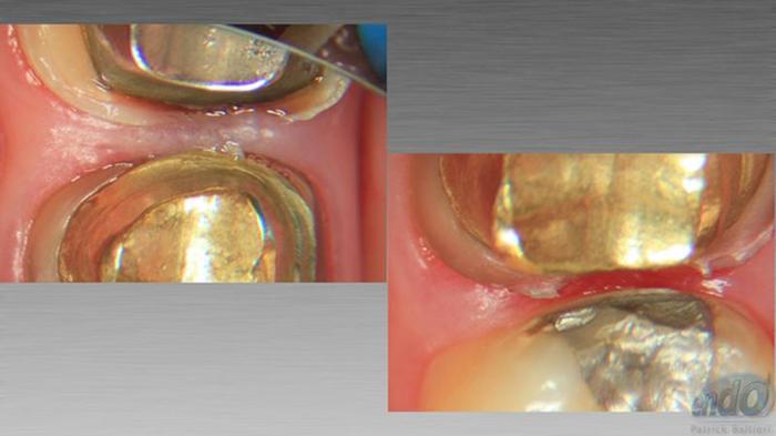 Retratamento Endodôntico Dente Caso clínico iDent