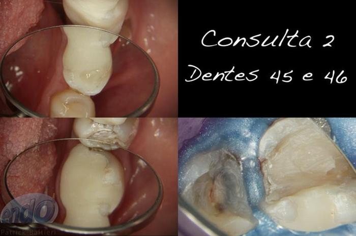 Tratamento Endod Ntico Dos Dentes Caso Cl Nico Ident