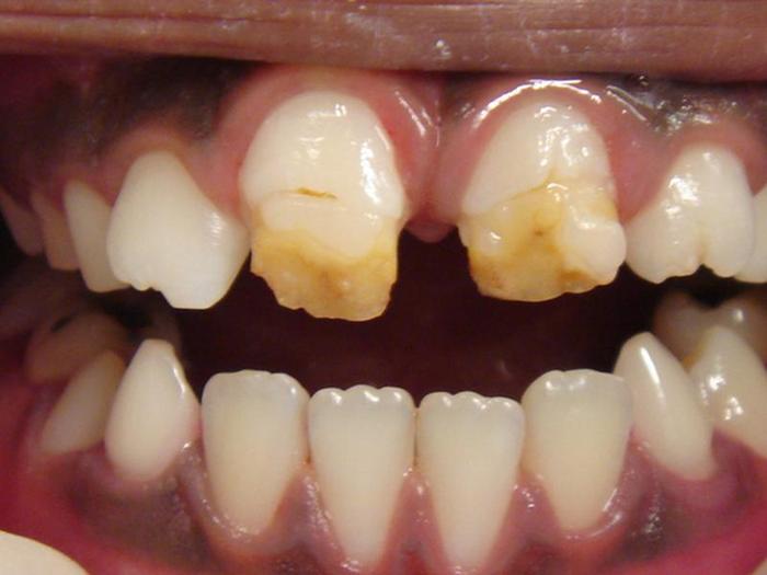 Hipoplasia De Esmalte Dente De Leite