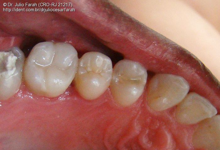 Restauração Em Resina Composta Dente Posterior Caso Clínico Ident 7211