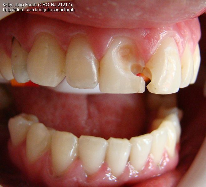 Restaurações Em Resina Composta Dentes Anteriores Caso Clínico Ident 5130