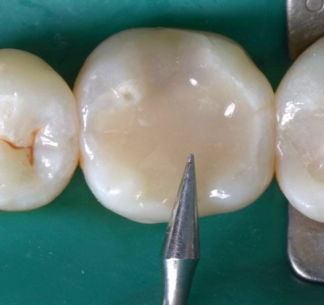 Restaura O Direta Em Dente Posterior Pela T Cnica Simplificada Bulk