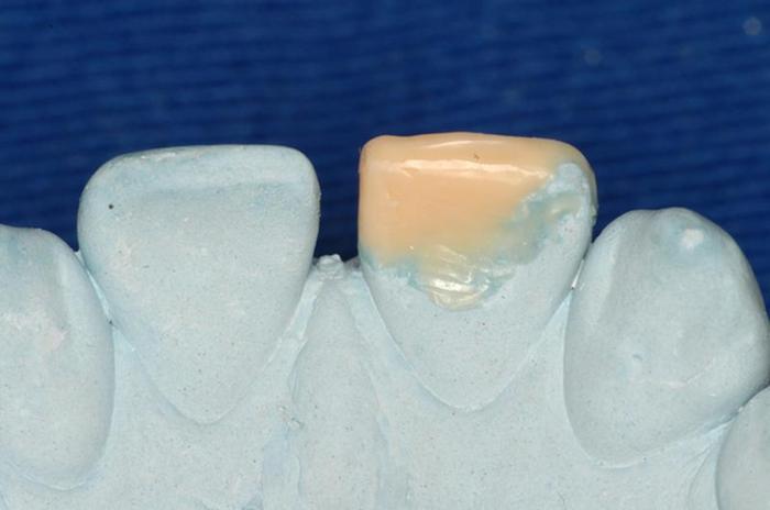 Restaura O De Dente Anterior Fraturado Associado Com Uso De Pinos De Fibra Intraradiculares