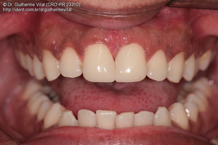 Fechamento De Diastema Com Resina Composta Caso Clínico Ident