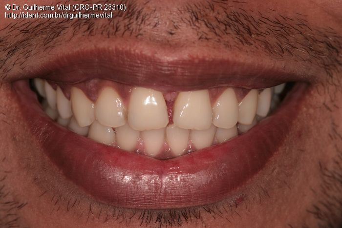 Fechamento De Diastema Com Resina Composta, Caso Clínico | IDent