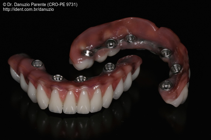 Protocolo Inferior Em Carga Imediata Implante Superior E Nova Pr Tese Caso Cl Nico Ident